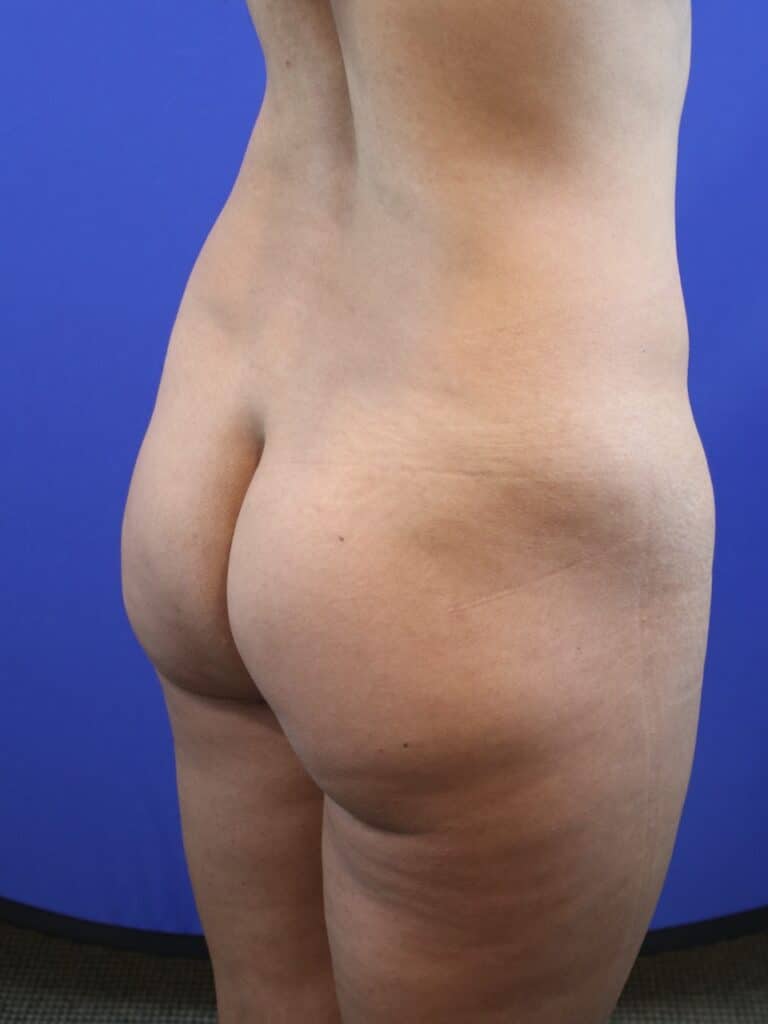 Before Image: Patient Case #4012 - right-back-oblique