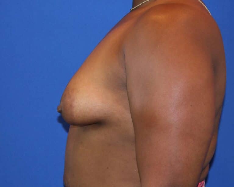 Before Image: Patient Case #3920 - left-side