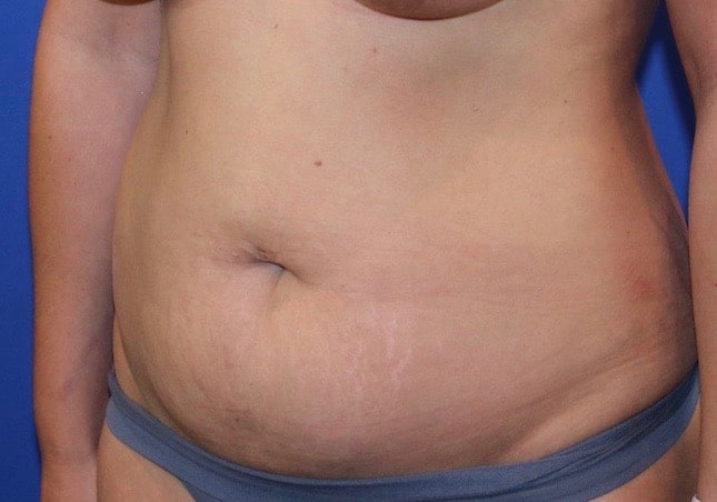 Before Image: Patient Case #3890 - left-front-oblique