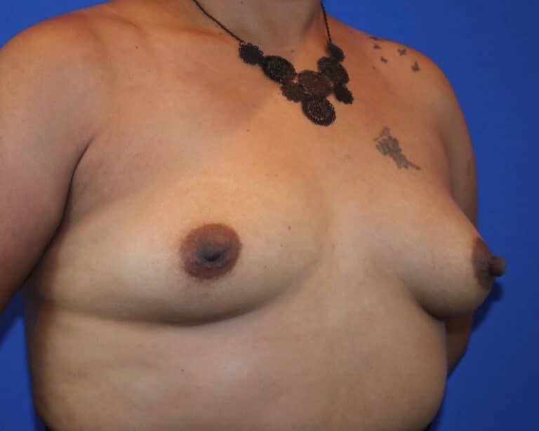 Before Image: Patient Case #5749 - right-front-oblique