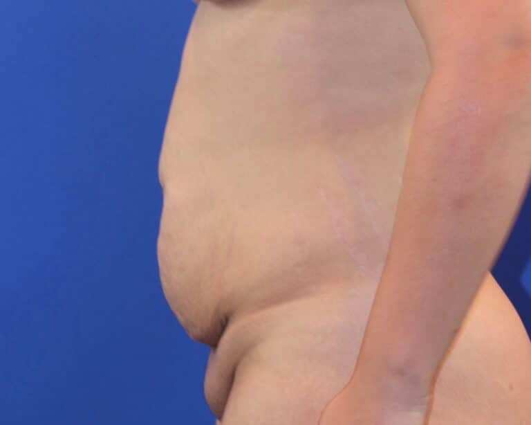 Before Image: Patient Case #3884 - left-side