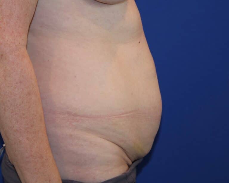 Before Image: Patient Case #3882 - right-side
