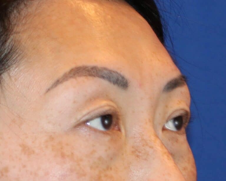 Before Image: Patient Case #3332 - right-front-oblique