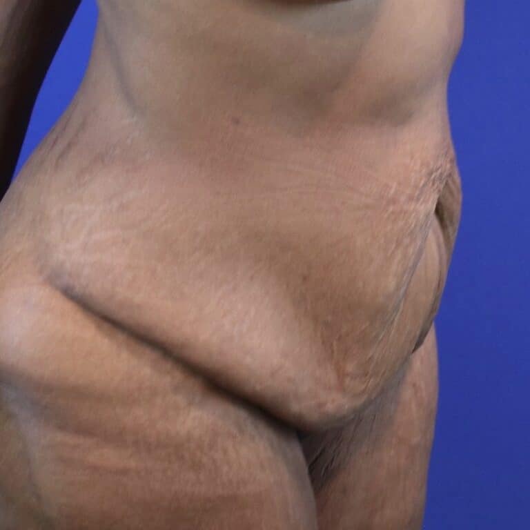Before Image: Patient Case #3119 - right-front-oblique