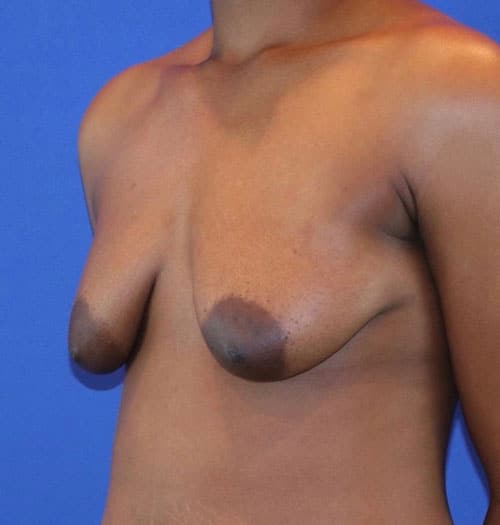 Before Image: Patient Case #3017 - left-front-oblique