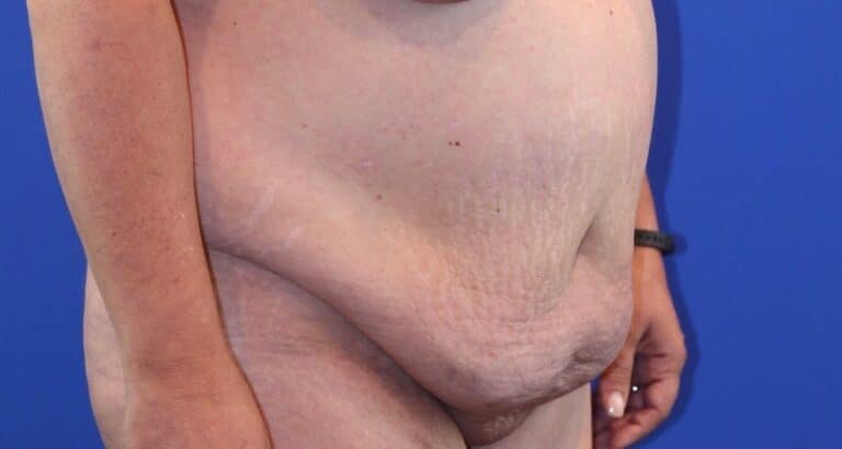 Before Image: Patient Case #3869 - right-front-oblique