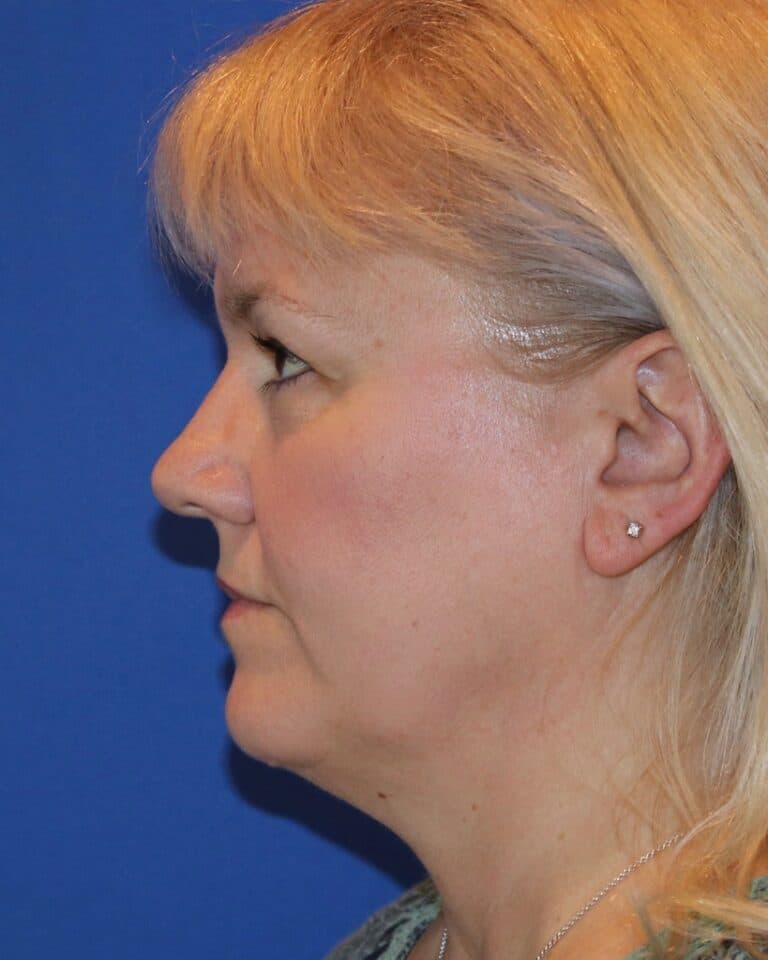 Before Image: Patient Case #3614 - left-side