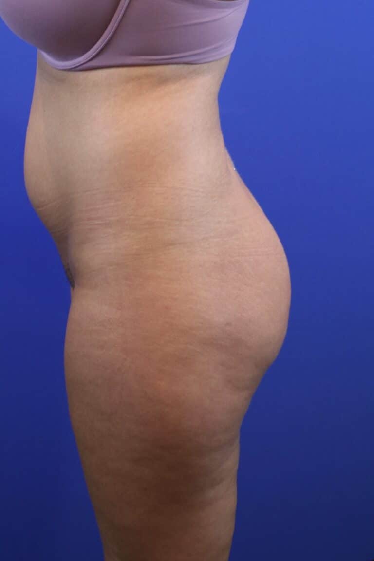 Before Image: Patient Case #4010 - left-side