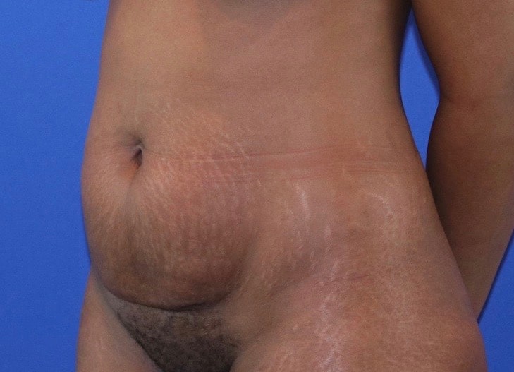 Before Image: Patient Case #3775 - left-front-oblique