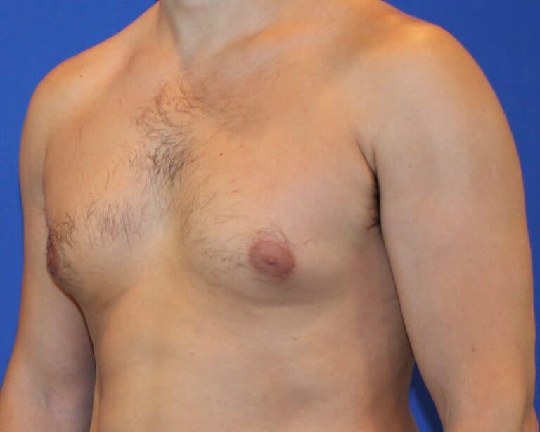 Before Image: Patient Case #1053 - left-front-oblique