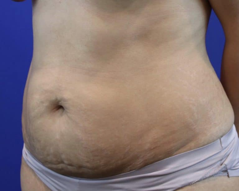 Before Image: Patient Case #3109 - left-front-oblique