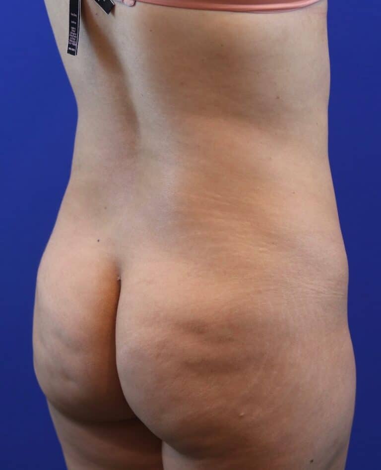 Before Image: Patient Case #4002 - right-back-oblique