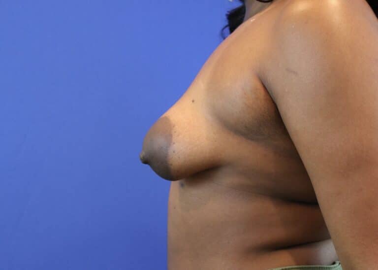 After Image: Patient Case #3423 - left-side