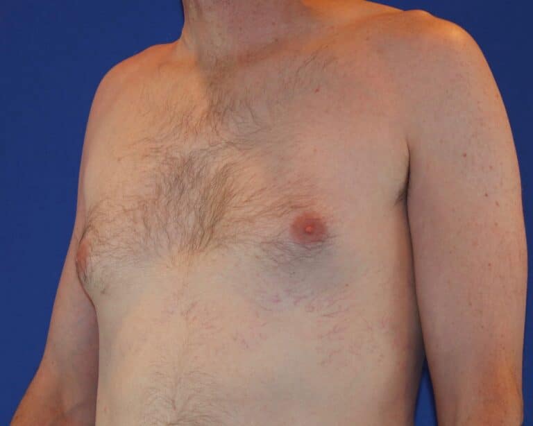 Before Image: Patient Case #1049 - left-front-oblique
