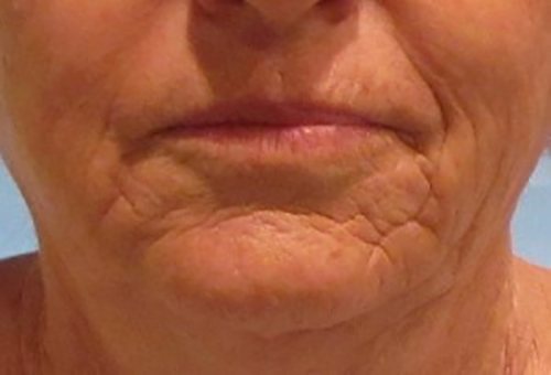 Before Image: Patient Case #3516 - front