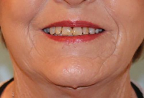 After Image: Patient Case #3516 - front