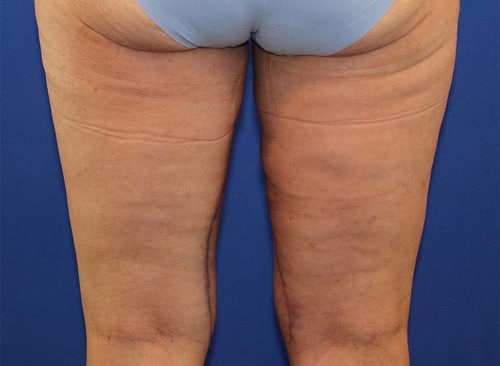 After Image: Patient 1 - back
