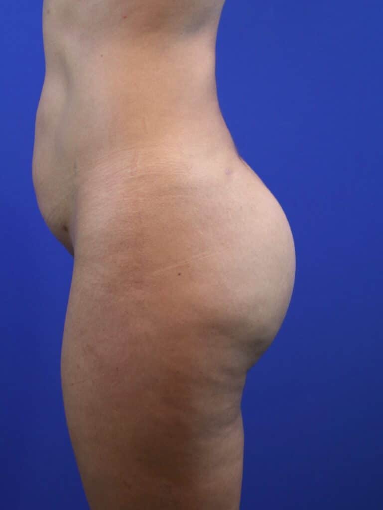 After Image: Patient Case #4012 - left-side