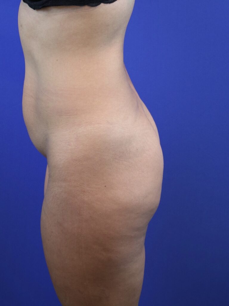 Before Image: Patient Case #4012 - left-side