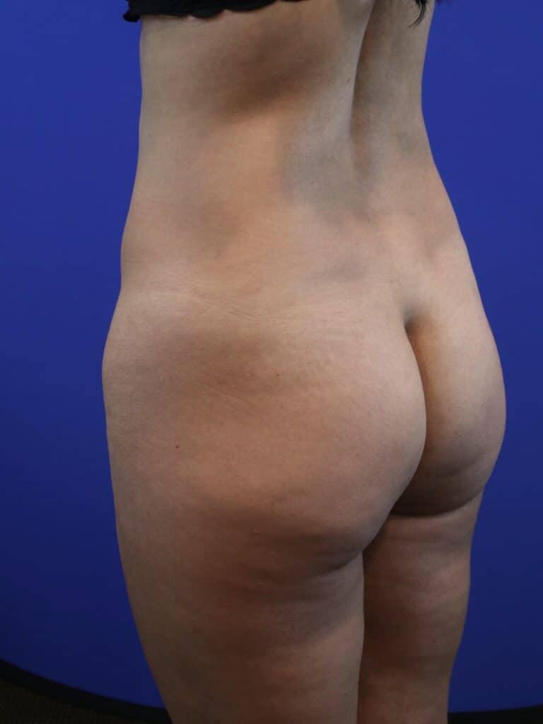 Before Image: Patient Case #4012 - left-back-oblique
