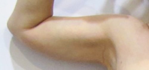 After Image: Patient Case #1104 - front