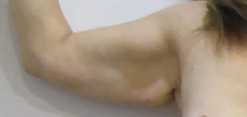Before Image: Patient Case #1104 - front