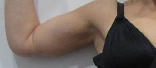 After Image: Patient Case #3003 - front