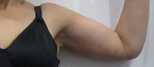 After Image: Patient Case #3003 - front