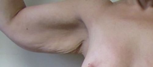 Before Image: Patient Case #3003 - front