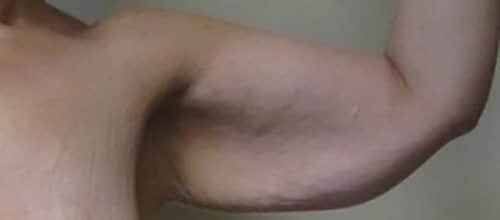 Before Image: Patient Case #3003 - front