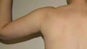 After Image: Patient Case #4847 - back