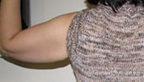 Before Image: Patient Case #4847 - back