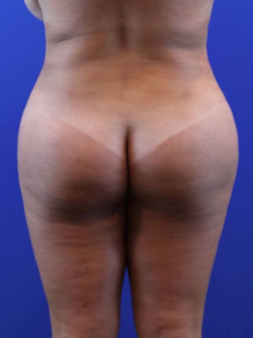 After Image: Patient Case #4000 - front