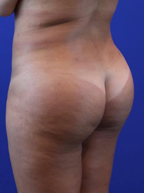 After Image: Patient Case #4000 - left-back-oblique