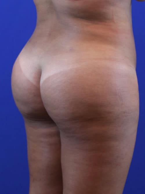 After Image: Patient Case #4000 - right-back-oblique