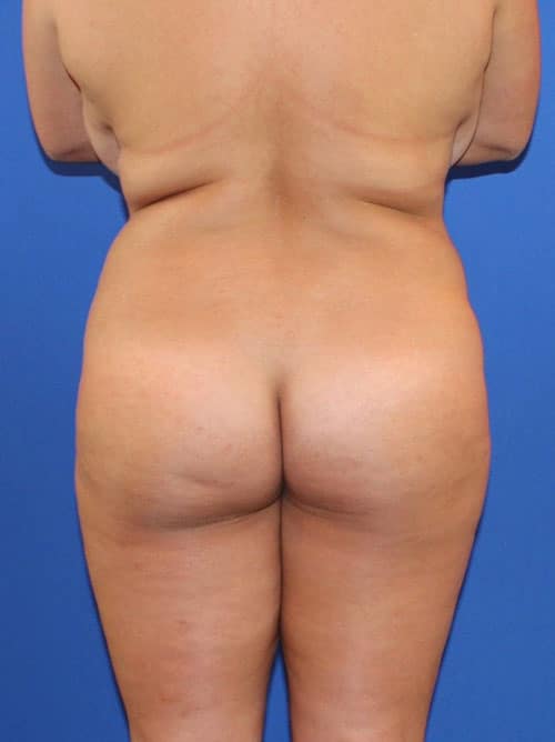 Before Image: Patient Case #4000 - front