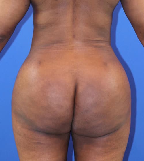 After Image: Patient Case #4005 - back