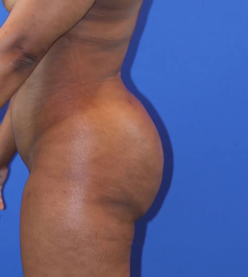After Image: Patient Case #4005 - left-side