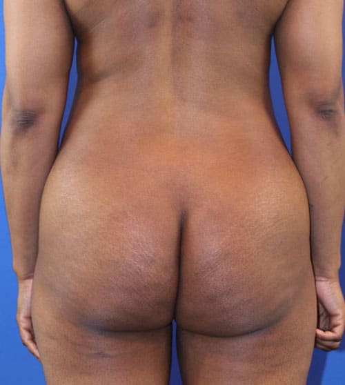 Before Image: Patient Case #4005 - back