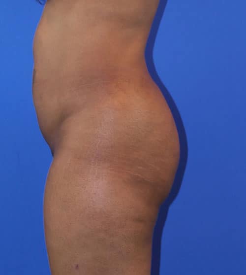 Before Image: Patient Case #4005 - left-side