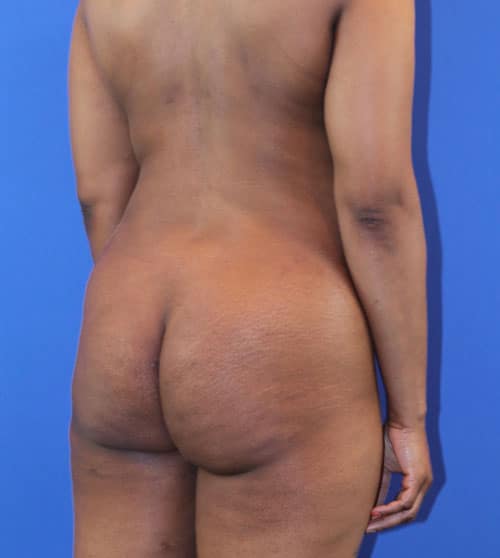 Before Image: Patient Case #4005 - right-back-oblique