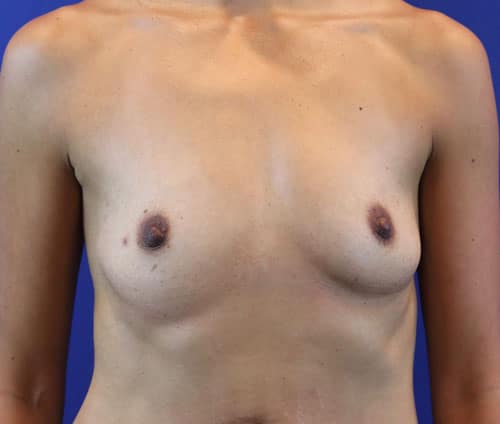 Before Image: Patient Case #2999 - front