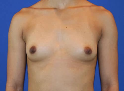 Before Image: Patient Case #3000 - front