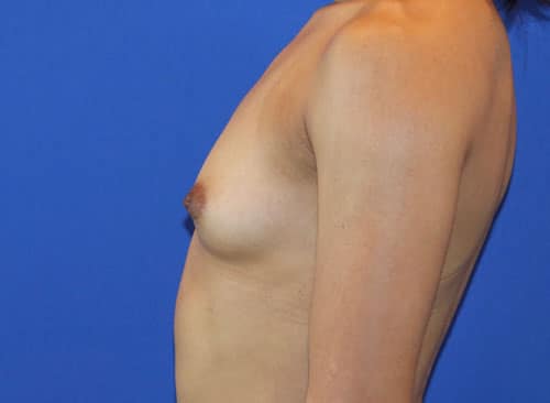 Before Image: Patient Case #3000 - left-side