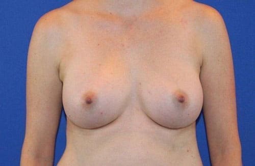 After Image: Patient Case #3750 - front