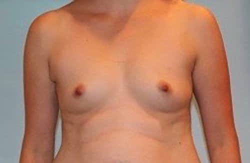 Before Image: Patient Case #3750 - front