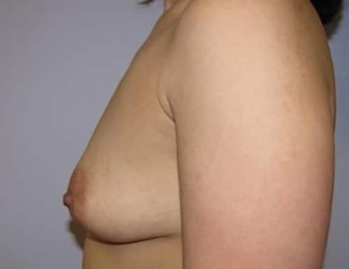 Before Image: Patient Case #3808 - left-side