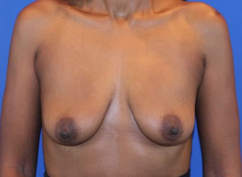 Before Image: Patient Case #3816 - front