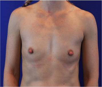 Before Image: Patient Case #3818 - front