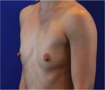 Before Image: Patient Case #3818 - left-front-oblique